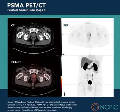 根治性前列腺切除术后 PSMA-PET指导的挽救性放疗强化或较优